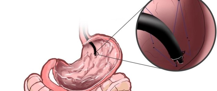 O que é Redução do estômago por endoscopia?